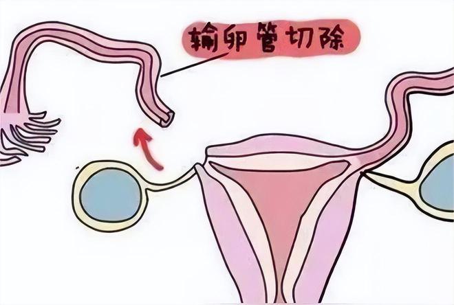 捐卵