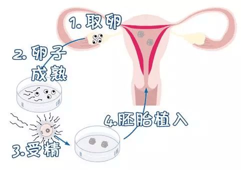 赴美生子